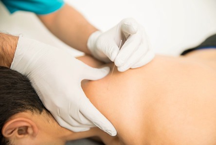 Dry needling treatment